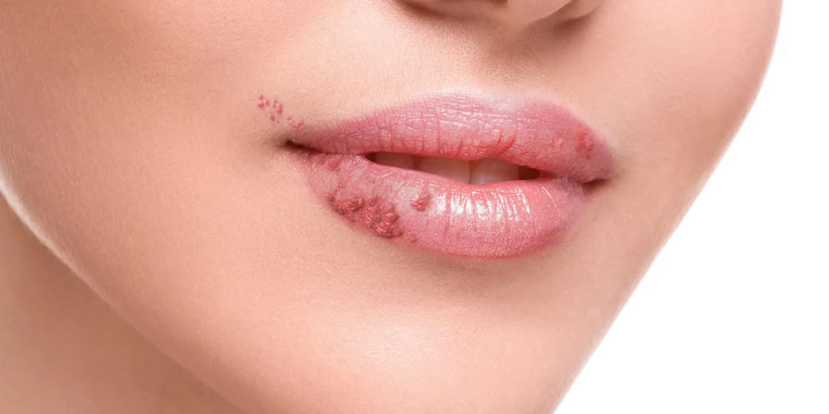 Herpes: sintomas, tipos, transmissão e tratamento